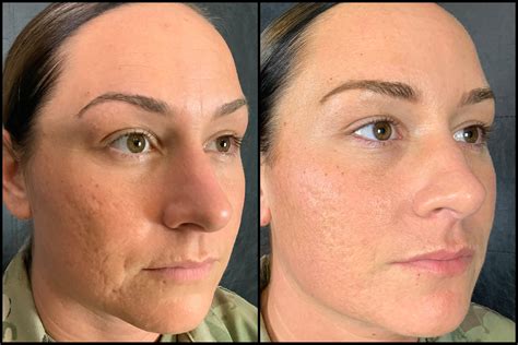 Microneedling Before And After Unlocking The Secrets To Rejuvenated