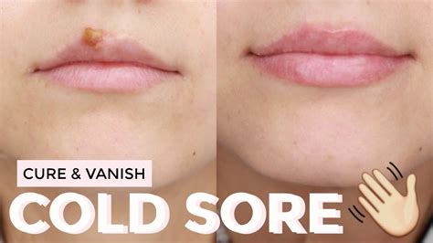 How To Heal Scabs On Lips Fast