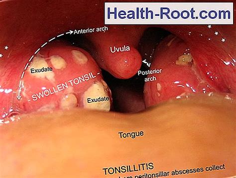 Parotitis is an inflammation of one or both parotid glands, the major salivary glands located on either side of the face, in humans. Pharyngeal disease (Parotitis epidemica) 🏥 Disease ...