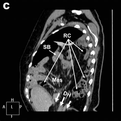 Symptomatic Bochdalek Hernia In An Adult Patient Bmj Case Reports