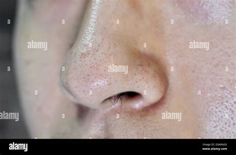 Blackheads Or Black Heads On Nose Of Asian Man They Are Small Bumps