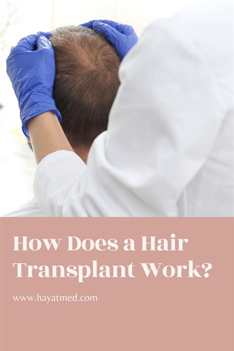 How Does Hair Transplant Works For Mens Hair Transplant Results