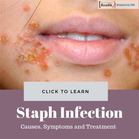 Stages Of Staph Infection