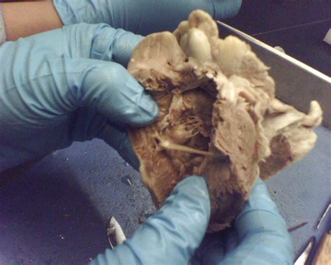 Hellerstein study of 150 cadaver hearts cs size correlated positively with right atrial size and right atrial pressure, but not with. Heart Experiement | x..SourTwin..x