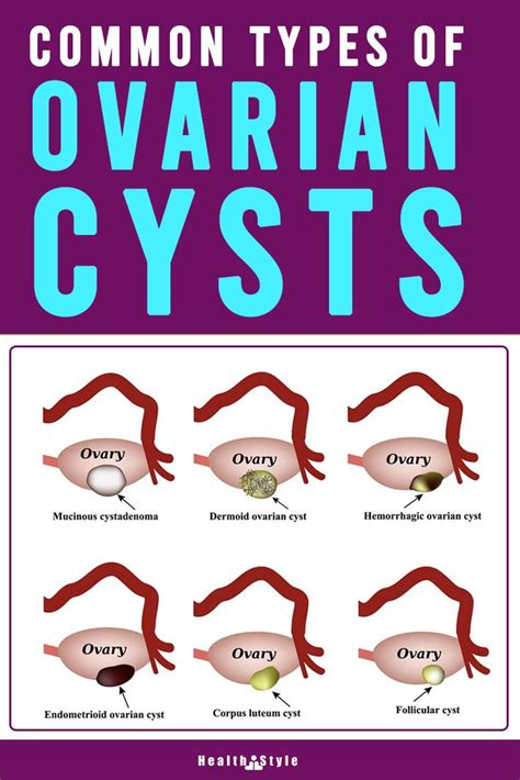 Ovarian Cysts What To Do And How It Effects You Ovarian Cyst Cysts