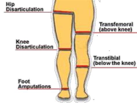 How I Do Below Knee Amputation
