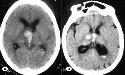 Non Contrast Ct Scan Of Head Showing Right Thalamic And Ivh Nine Years