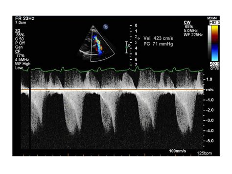 Parasternal Long Axis Pulm Valve Pediatric Echocardiography