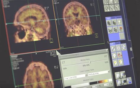 How Pet Scans Of The Brain Reveal The Microscopic Signs Of Alzheimers