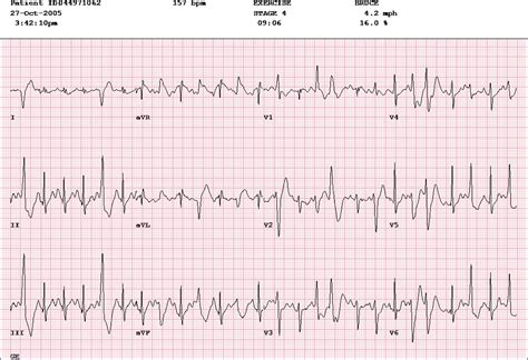 Catecholaminergic Polymorphic Ventricular Tachycardia Doctorvisit