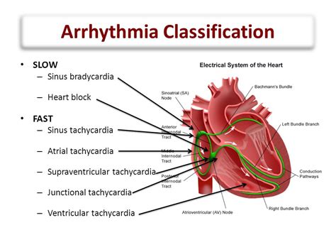 Arrhythmia Classification Ibg News