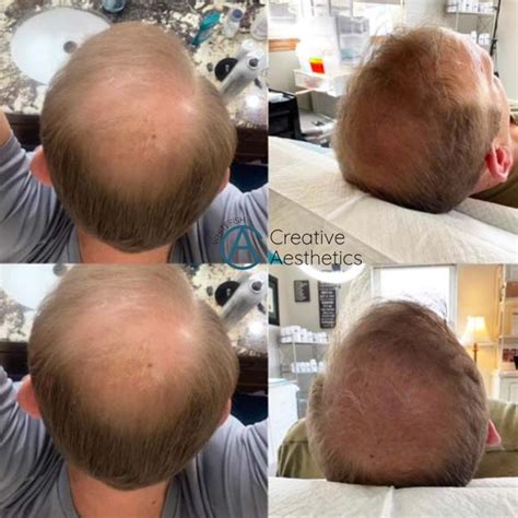 Platelet Rich Fibrin Prf Prp Hair Loss Treatment In Whitefish