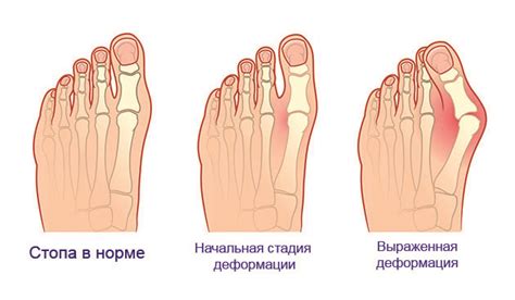 Косточка на большом пальце ноги симптомы причины лечение