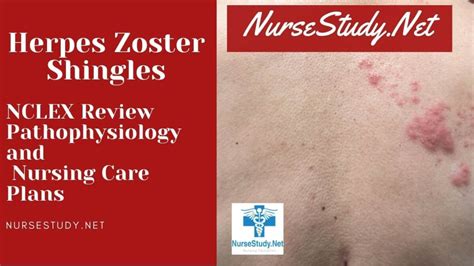 Herpes Zoster Shingles Nursing Care Plans And Diagnosis Interventions
