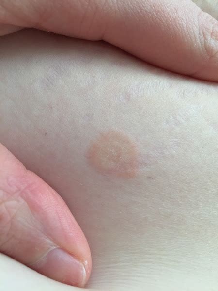 Ringworm Picture Attached Mumsnet