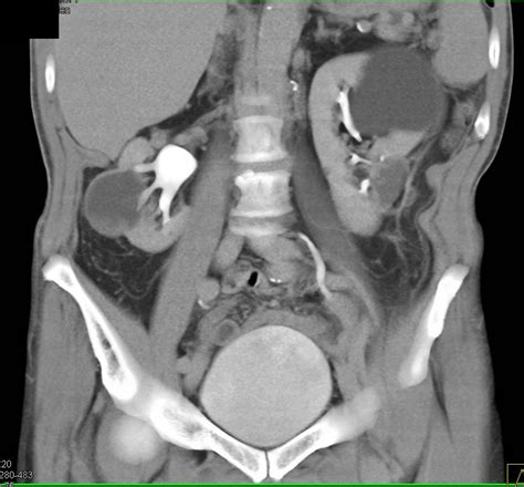 Complex Cystic Lesions With Ablations Both Kidneys Kidney Case