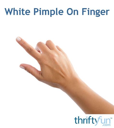White Pimple On Finger Thriftyfun