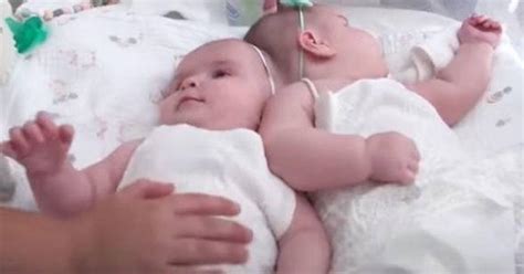 Nine Month Old Twins Conjoined At Head Are Successfully Separated In