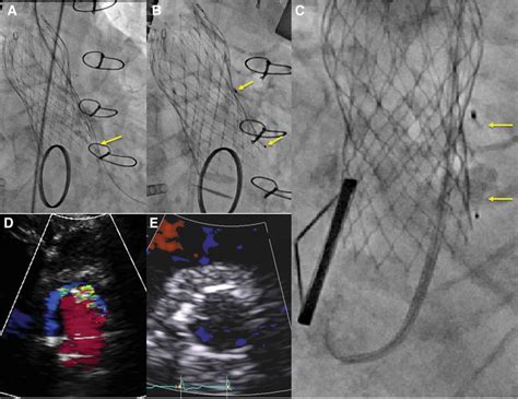 Techniques And Outcomes For The Treatment Of Paravalvular Leak