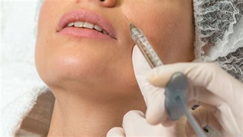 The Best Dermal Fillers For Lines Around The Mouth • Medisilk