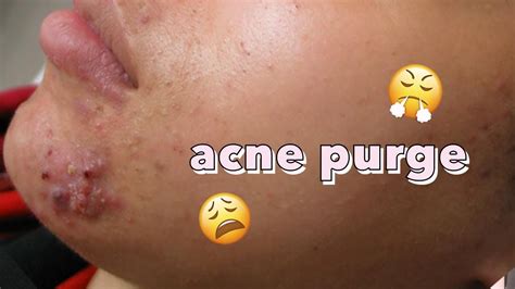 Skin Purging Does Acne Have To Get Worse Before It Gets Better Youtube
