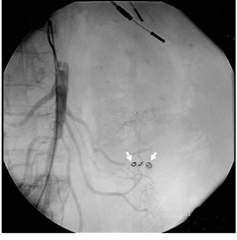 Postembolization Control Selective Superior Mesenteric Artery Angiogram