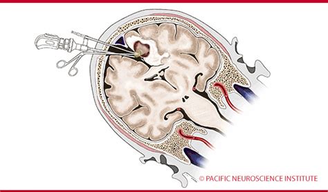 An Illustration Of Brain Surgery Pacific Neuroscience Institute