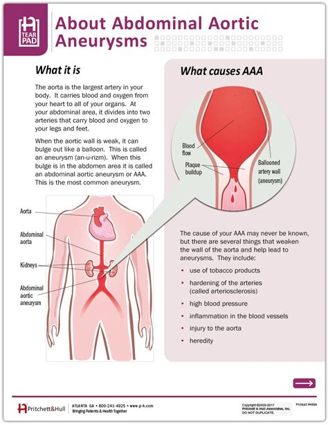 Abdominal Aortic Aneurysm Tearpad 50 Sheets Per Pad Pritchett And Hull Nursing Cheat