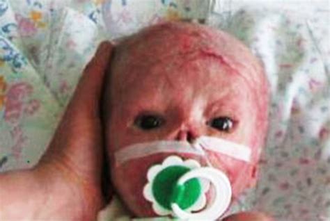 Baby Matvey Looks For A New Home After Suffering 70 Burns In Fire