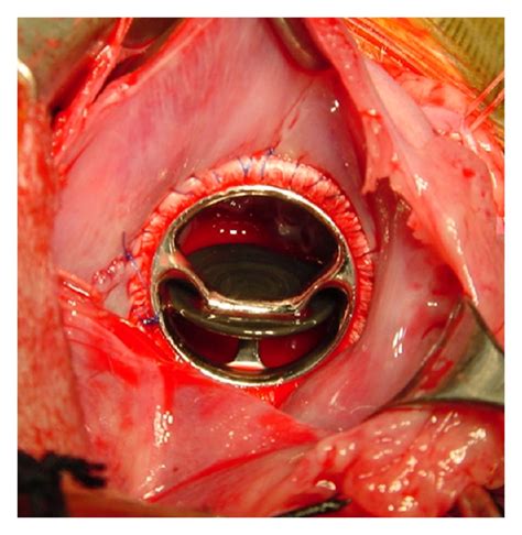 Mitral Valve Replacement With A Mechanical Valve For Severe Mitral