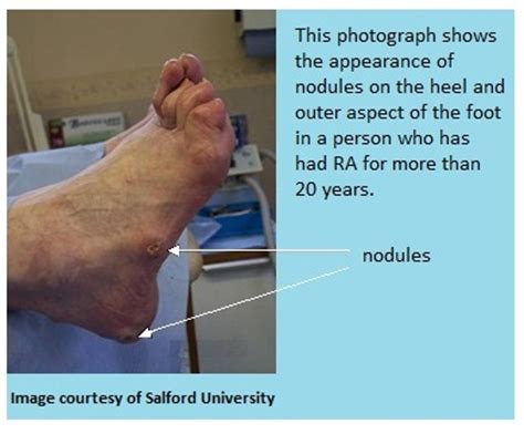 The Foot And Rheumatoid Arthritis Nras