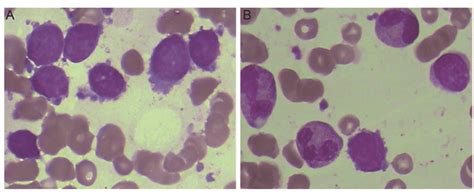 A Diffuse Large B Cell Lymphoma With Bone Marrow Bm Involvement Was