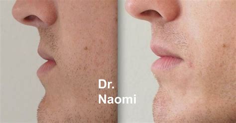 Male Cosmetic Treatments Best Clinic Sydney For Dermal Fillers