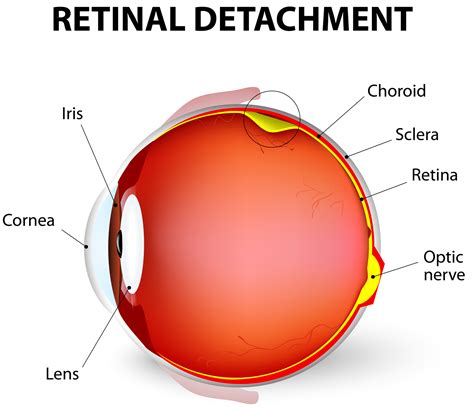 Retinal Detachment Causes Signs Symptoms Surgery Repair