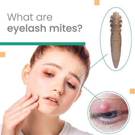 What Are Eyelash Mites There Are Two Types Of Demodex Mites Called Demodex Folliculorum And