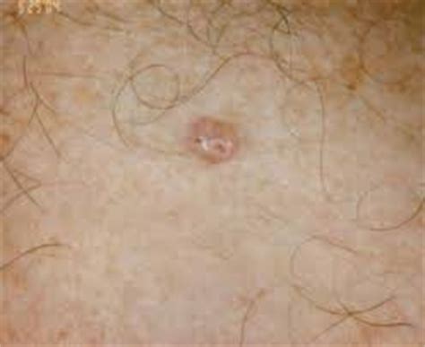 There are 5 main groups. Basal cell carcinoma