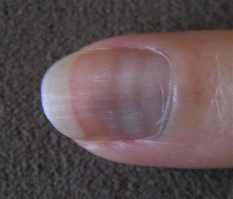 This is a very common issue and entirely harmless. White spots on nails: Causes, prevention, and treatment