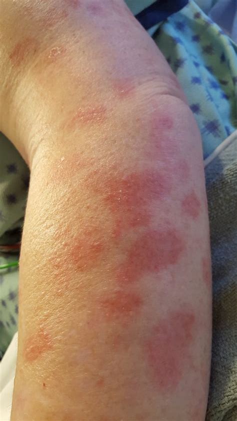 Erythema Multiforme Overview Causes Symptoms Treatment