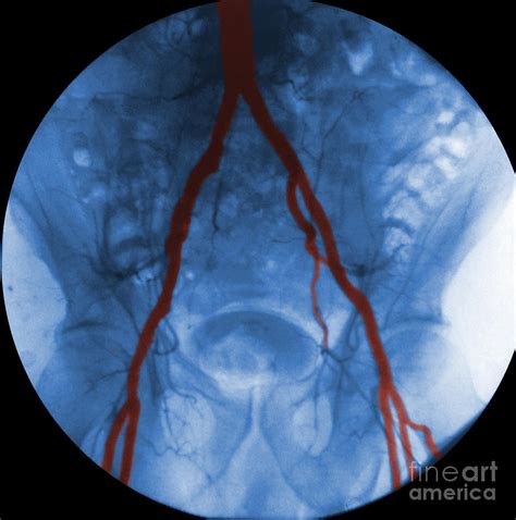 Angiogram Of Iliac Arteries Photograph By Omikron Fine Art America