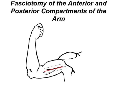 Compartment Syndrome And Fasciotomy Supparerk Prichayudh M D