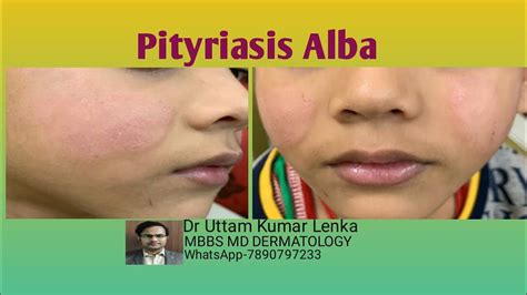 What Is Pityriasis Albatreatmentprevention White Spots On Cheek Of