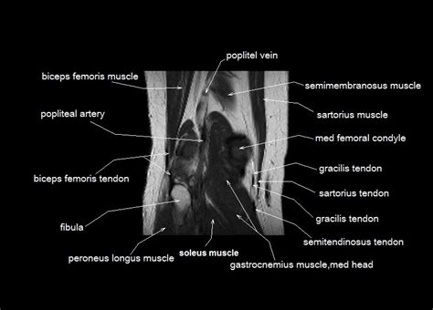 12 photos of the knee muscle anatomy mri. knee anatomy | MRI knee coronal anatomy | free cross ...