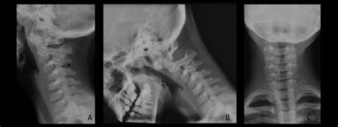 Plain Films Of Cervical Spine After Whiplash Trauma In A 12 Year Old