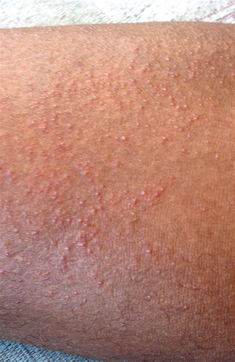 What Is Prickly Heat Rash