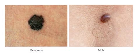 Difference Between Mole And Melanoma Of The Skin Download Scientific