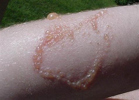 Three Myths And Facts About Poison Ivy Rash Appalachian Mountain Club