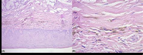 Extensive Hard Palate Hyperpigmentation Associated With Chloroquine Use