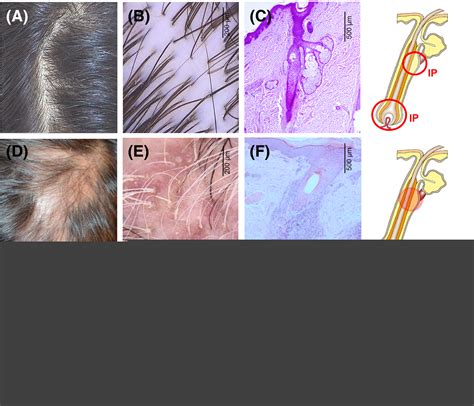The Role Of The Microbiome In Scalp Hair Follicle Biology And Disease