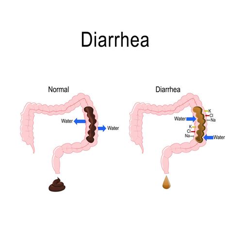 Healing Persistent Diarrhoea Dr Chiro Chiropractors In Singapore