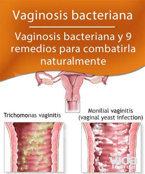 Vaginosis Bacteriana Causas Y Remedios Para Combatirla Infeccion The Best Porn Website